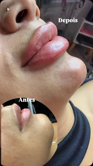 Lábios antes e depois do preenchimento, com a foto de antes em destaque no canto